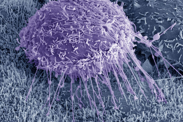 Ovarian Cancer Cell