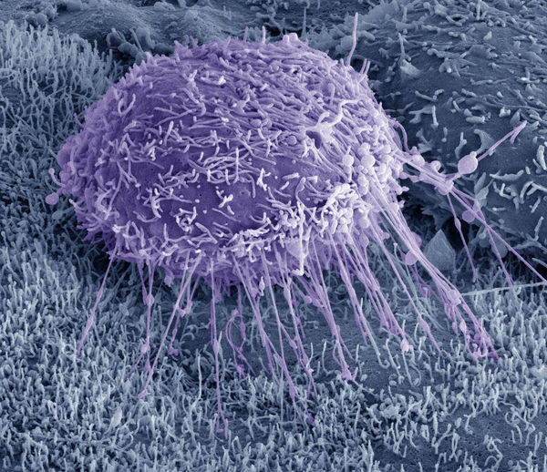 Ovarian Cancer Cell
